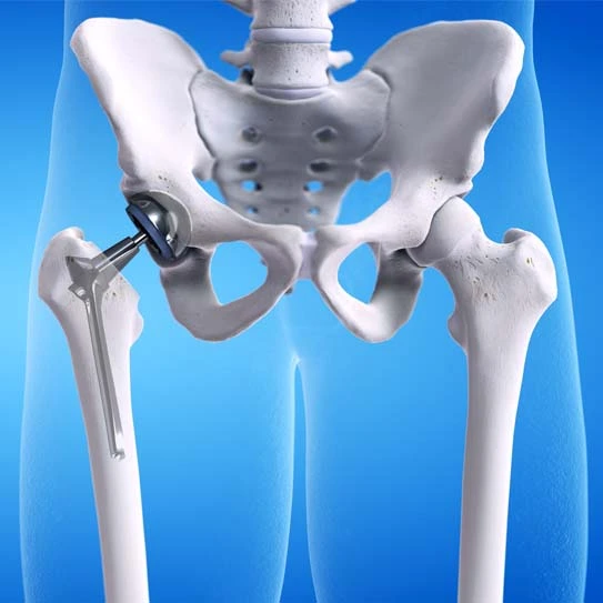 Best Hip Replacement Specialist in Guntur